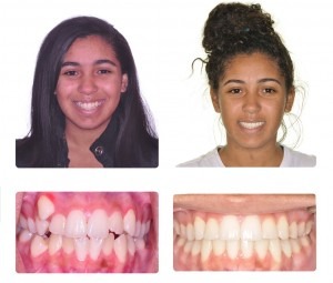 Before and after treatment